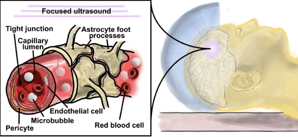 Improving Drug Therapy Penetration into the Substantia Nigra Using Focused Ultrasound in Early Parkinson’s Disease  | VS Buzaev International MRgFUS Medical Treatment Centre Improving Drug Therapy Penetration into the Substantia Nigra Using Focused Ultrasound in Early Parkinson's Disease