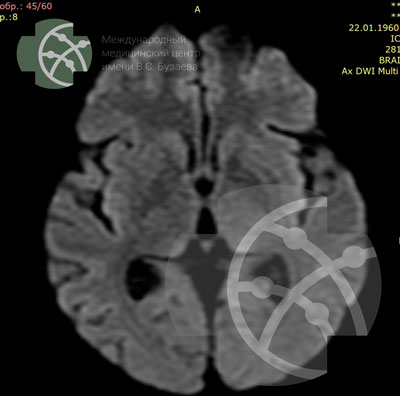 MRI of the Brain: DWI Program  | VS Buzaev International MRgFUS Medical Treatment Centre MRI of the Brain: DWI Program