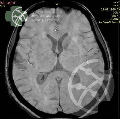 MRI of the Brain: SWAN Program  | VS Buzaev International MRgFUS Medical Treatment Centre MRI of the Brain: SWAN Program