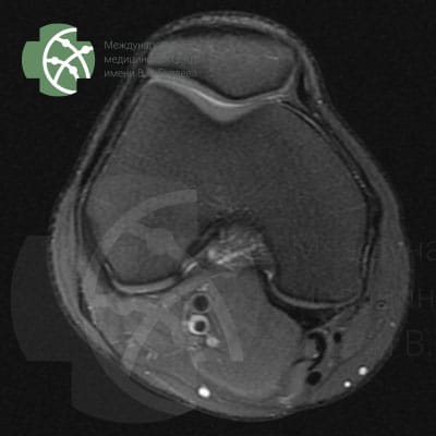 MRI of the knee joint. Program PD FS Axial 3 mm.  | VS Buzaev International MRgFUS Medical Treatment Centre MRI of the Knee Joint. Program PD FS Axial 3 mm.