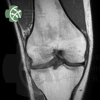 MRI of the knee area - joint and surrounding tissues. T1 coronal 3 mm program.  | VS Buzaev International MRgFUS Medical Treatment Centre MRI of the knee area - joint and surrounding tissues. Program T1 coronal 3 mm.