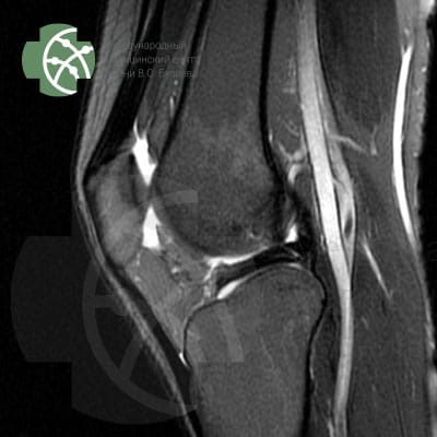 MRI of the knee joint. Program T2 FS Sagittal 3 mm.  | VS Buzaev International MRgFUS Medical Treatment Centre MRI of the knee joint. Program T2 FS Sagittal 3 mm.