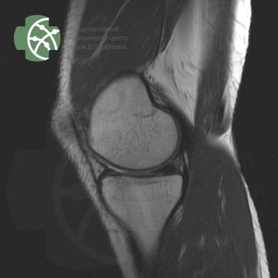 MRI of the knee area - joint and surrounding tissues. Program T2 FS sagittal 3 mm  | VS Buzaev International MRgFUS Medical Treatment Centre MRI of the knee area - joint and surrounding tissues. T2 FS sagittal 3 mm program