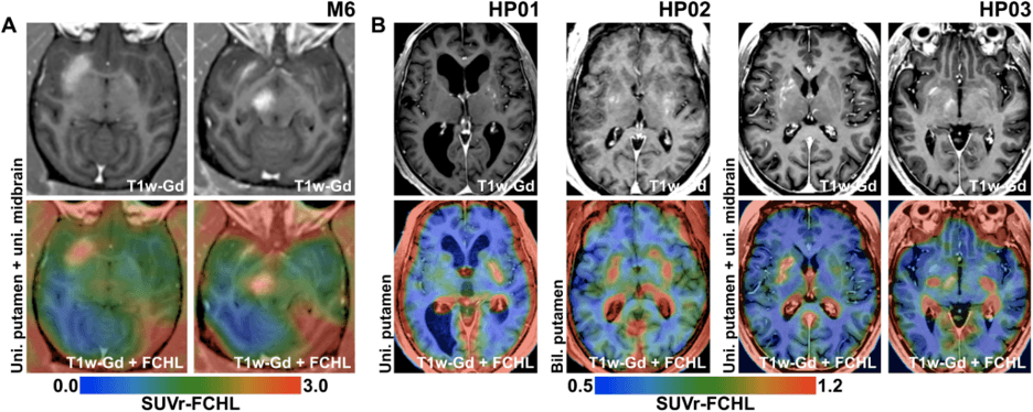 Gene Therapy for Parkinson's Disease 
