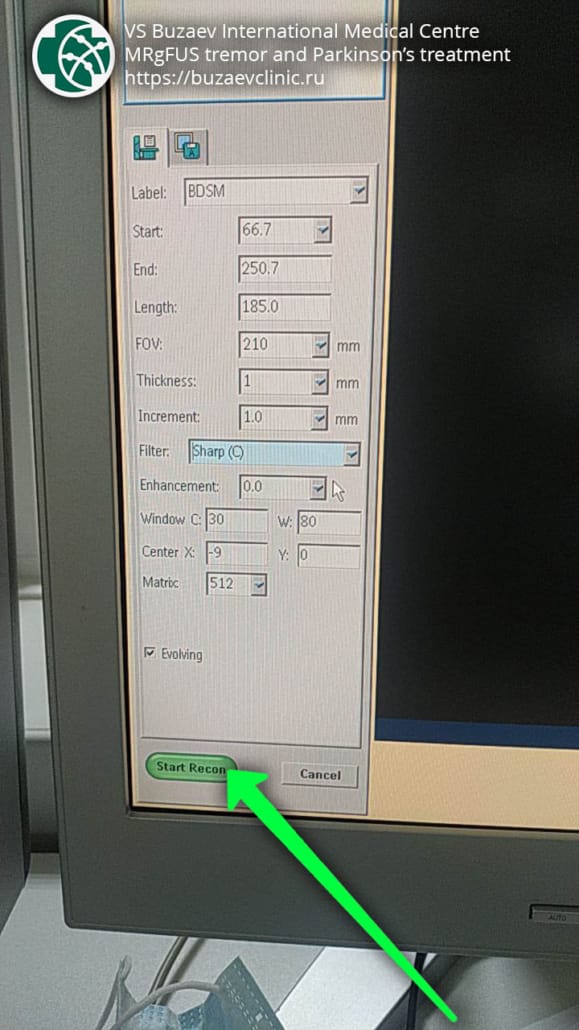 Philips CT machine: how to perform CT scan for MRgFUS preplan?