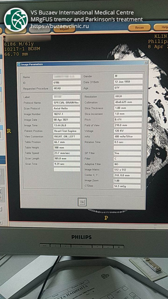 CT protocol for preliminary planning of tremor or Parkinson's disease treatment using MRI-guided focused ultrasound: Philips
