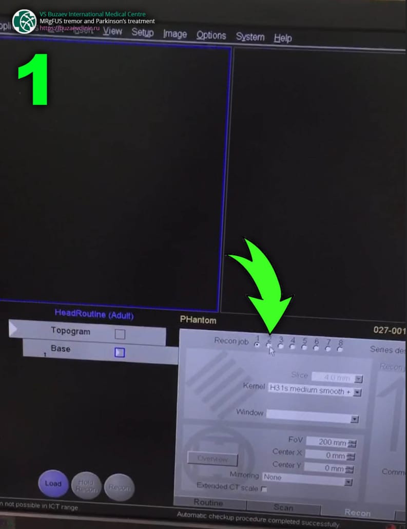 Siemens CT machine: how to perform CT scan for MRgFUS preplan