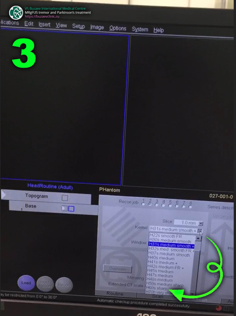 CT protocol for preliminary planning of tremor or Parkinson's disease treatment using MRI-guided focused ultrasound: Siemens