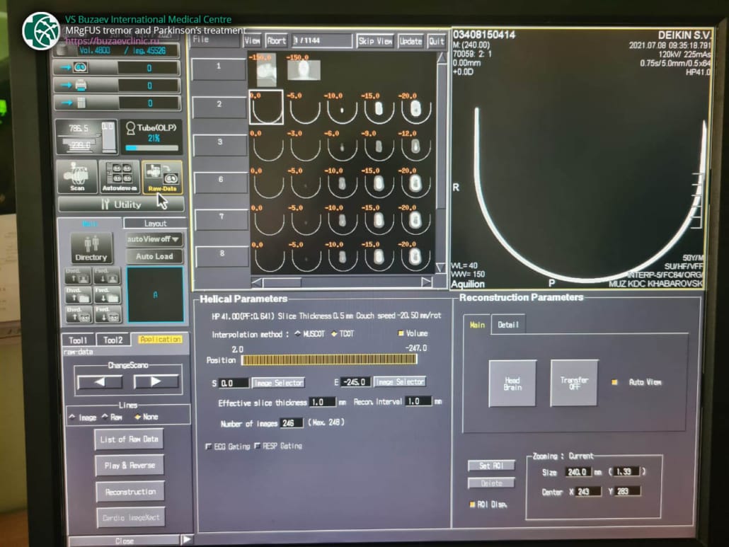 Toshiba CT machine: how to perform CT scan for MRgFUS preplan