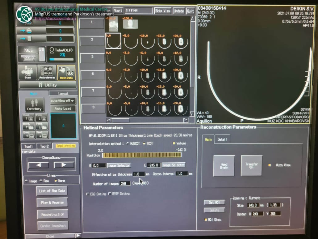 Toshiba CT machine: how to perform CT scan for MRgFUS preplan