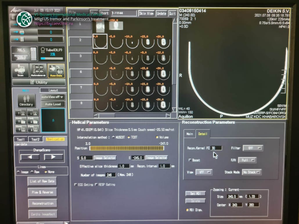 Toshiba CT machine: how to perform CT scan for MRgFUS preplan