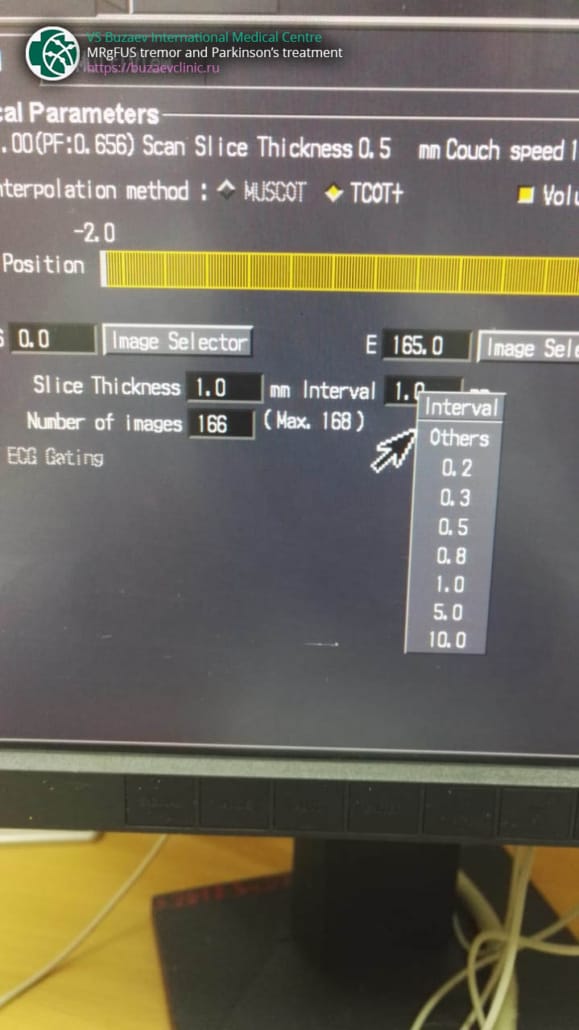 Toshiba CT machine: how to perform CT scan for MRgFUS preplan