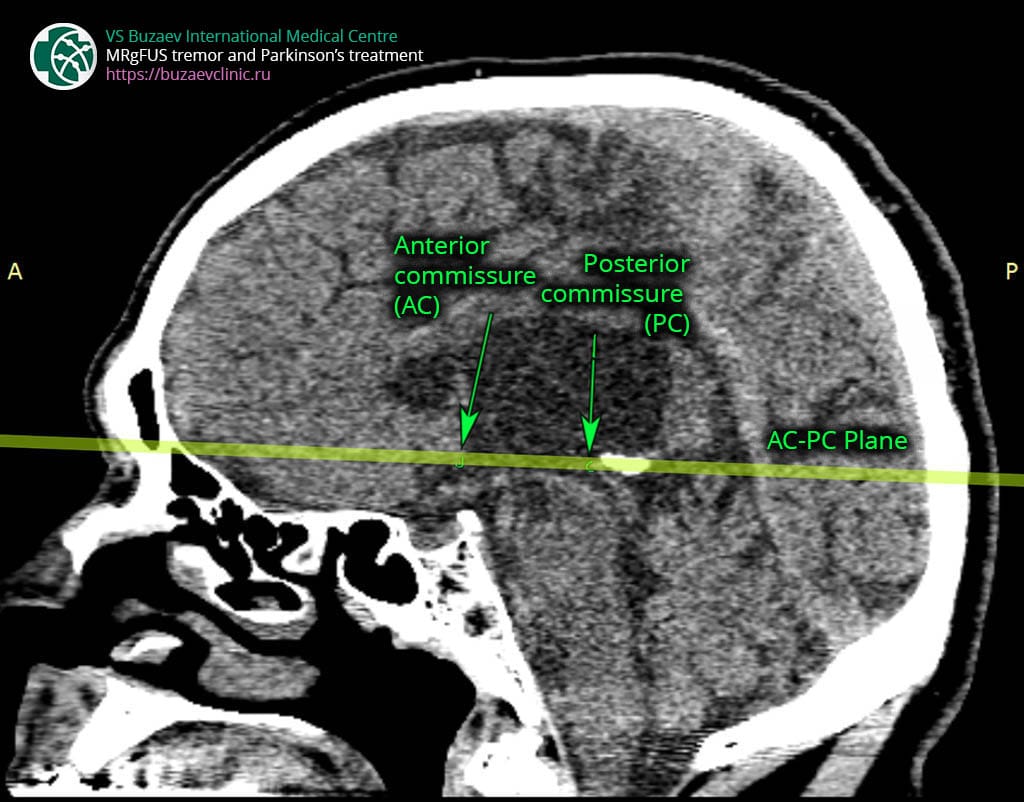 Computer tomography protocol for MRgFUS preplan: AC-PC plane