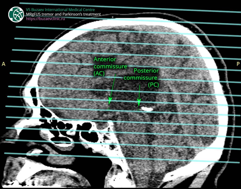 Computer tomography protocol for MRgFUS preplan: AC-PC plane with slice lines