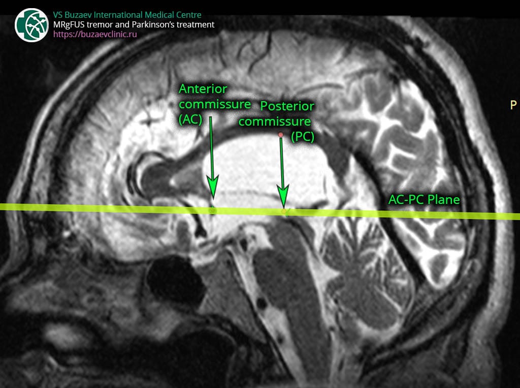 Computer tomography protocol for MRgFUS preplan: MRI plane AC-PC