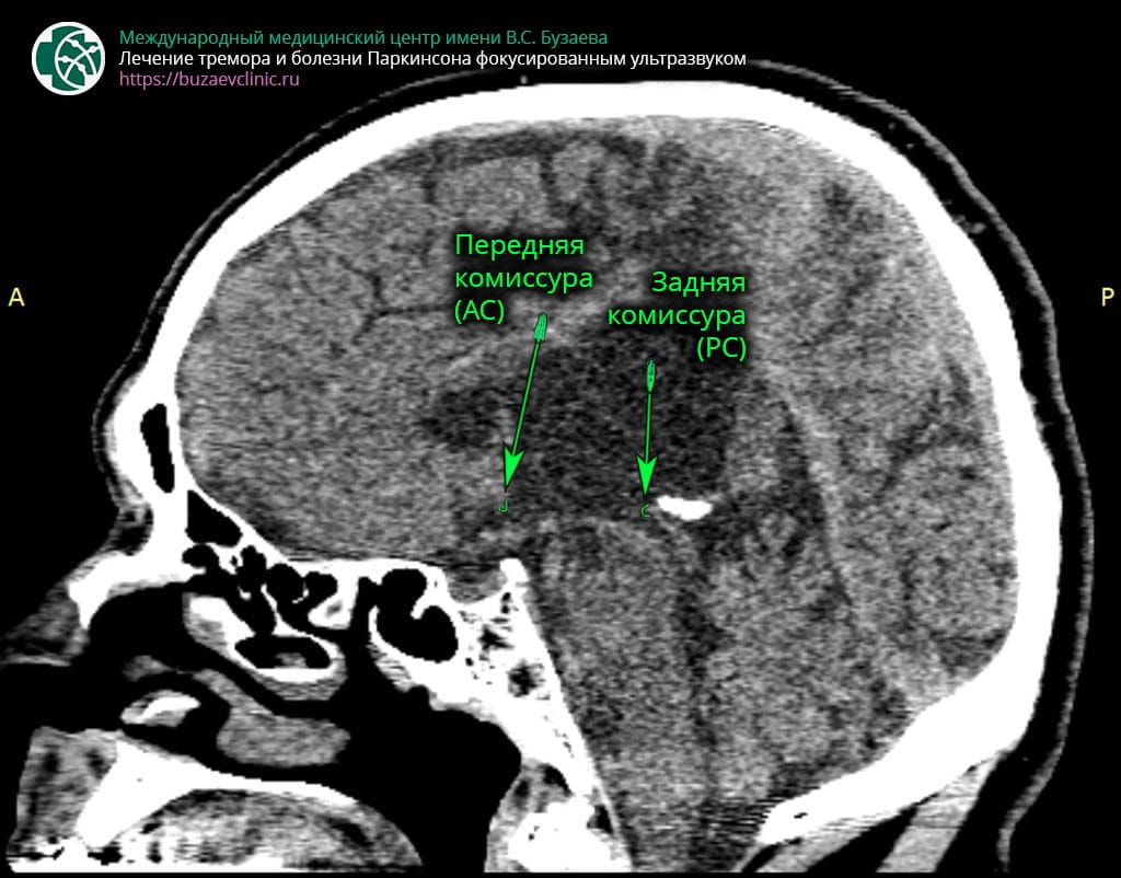 CT protocol for preliminary planning of tremor or Parkinson's disease treatment using MRI-guided focused ultrasound: determination of anterior points AC and the posterior commissure PC