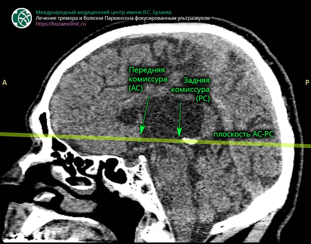CT protocol for preliminary planning of tremor or Parkinson's disease treatment using MRI-guided focused ultrasound: AC-PC plane 