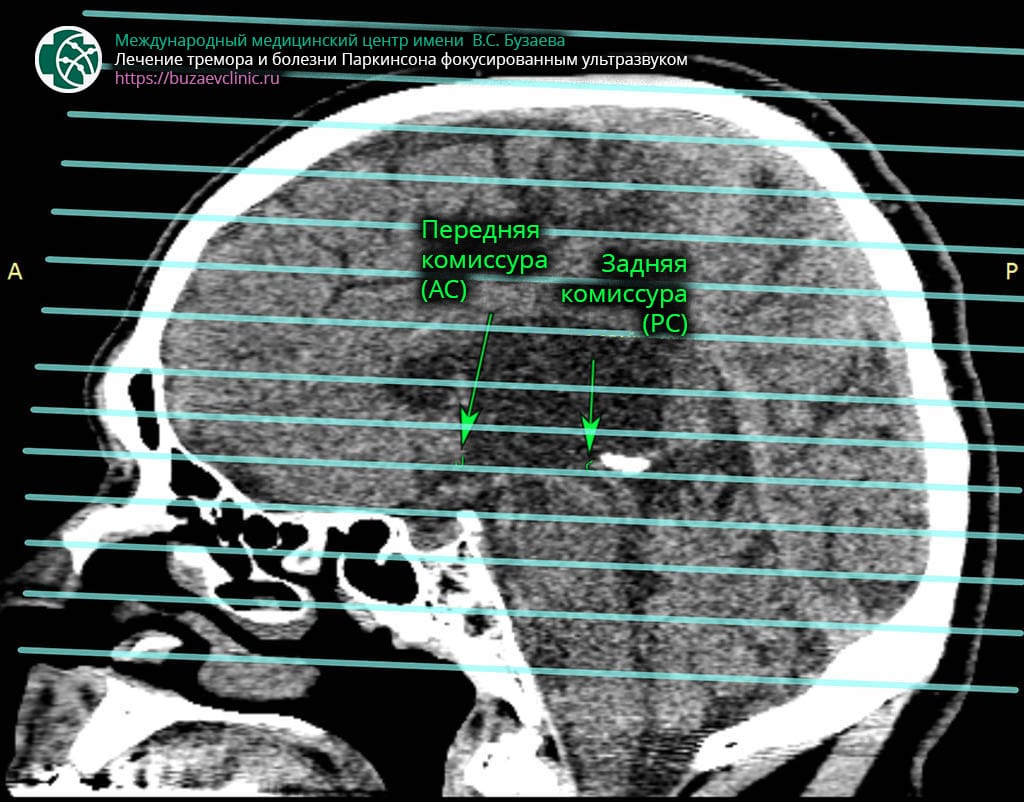 CT protocol for preliminary planning of tremor or Parkinson's disease treatment using MRI-guided focused ultrasound: plane AC-PC with lines of all slices 