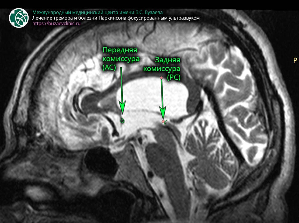 CT protocol for preliminary planning of tremor or Parkinson's disease treatment using MRI-guided focused ultrasound: determination of the anterior AC) and posterior PC) commissure on MRI 