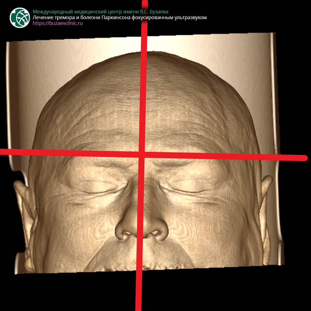 CT scan protocol for preliminary planning of tremor or Parkinson's disease treatment using MRI-guided focused ultrasound: patient positioning on the CT table 