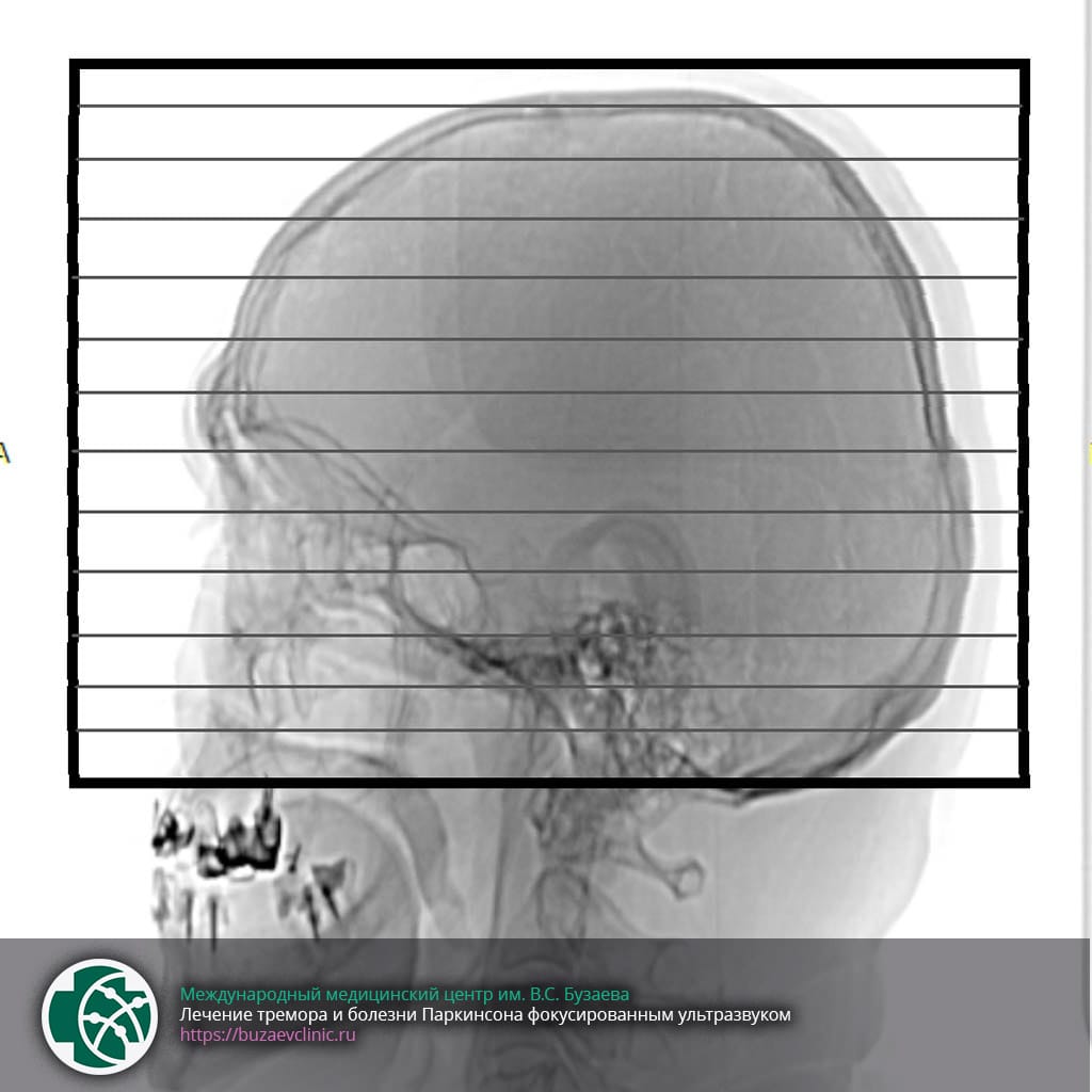 CT scan protocol for preliminary planning of tremor or Parkinson's disease treatment using MRI-guided focused ultrasound: CT scan area 