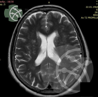 MRI of the brain: T2 Axial  | VS Buzaev International MRgFUS Medical Treatment Centre MRI of the brain: T2 Axial