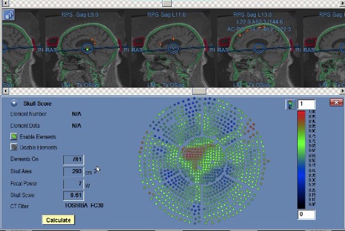 Figure 4.4. Calculation of the Skull Score for Ultrasound Conductivity Coefficient. | VS Buzaev International MRgFUS Medical Treatment Centre Figure 4.4. Calculation of the ultrasound conductivity coefficient of bone tissue ( Scull Score).