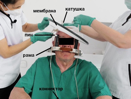 Figure 4.6. A neurosurgeon and an operating nurse are applying a membrane. | VS Buzaev International MRgFUS Medical Treatment Centre Figure 4.6. A neurosurgeon and a surgical nurse are applying the membrane.