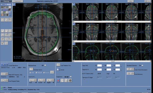 Figure 5.4. Obtaining a hybrid CT and MRI image. | VS Buzaev International MRgFUS Medical Treatment Centre Figure 5.4. Obtaining a hybrid CT and MRI image.