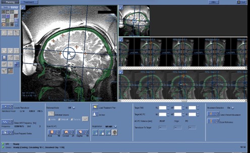 Figure 5.5. Placement of Fiducial Markers | VS Buzaev International MRgFUS Medical Treatment Centre Figure 5.5. Placement of Fiducial Markers