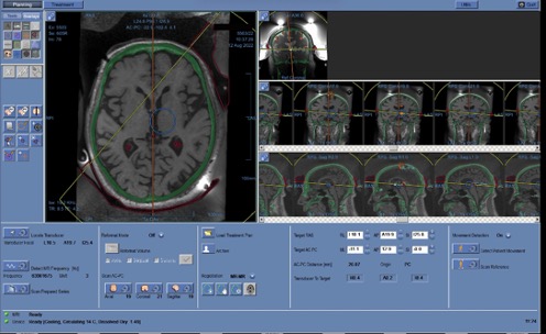 Figure 5.6. Marking of "prohibited" areas for ultrasound | VS Buzaev International MRgFUS Medical Treatment Centre Figure 5.6. Marking of