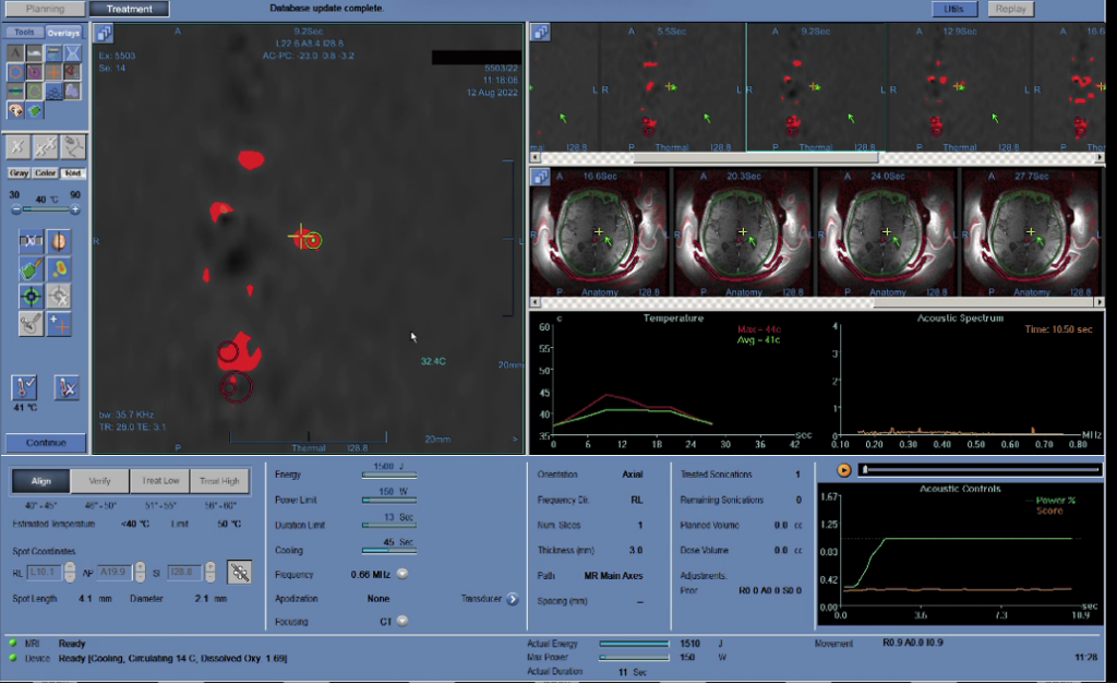 Figure 5.7 Stage of Anatomical Verification | VS Buzaev International MRgFUS Medical Treatment Centre Figure 5.7 Stage of Anatomical Verification