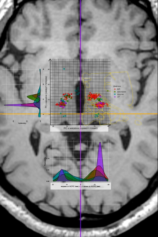Figure 5.9. Map and density diagrams of patient sonications in the axial plane passing through the AC-PC line. | VS Buzaev International MRgFUS Medical Treatment Centre Figure 5.9. Map and density diagrams of patient sonications in the axial plane passing through the line AC-PC.