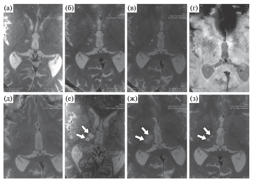 Fig. 7.5. MRI of the brain of patient R., born in 1950, in the axial plane. a – immediately after the 1st stage of thalamotomy using the MRgFUS method, mode | VS Buzaev International MRgFUS Medical Treatment Centre Fig. 7.5. MRI of the brain of patient R., born in 1950, in the axial plane. a – immediately after the 1st stage of thalamotomy using the MRgFUS method, mode