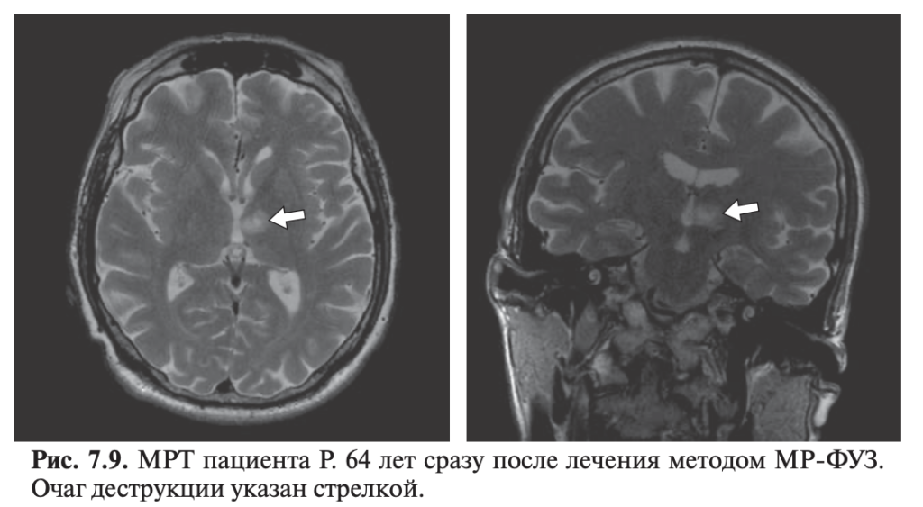 Fig. 7.9. MRI of patient R., 64 years old, immediately after treatment with the MRgFUS method. The focus of destruction is indicated by an arrow. | VS Buzaev International MRgFUS Medical Treatment Centre Fig. 7.9. MRI of patient R., 64 years old, immediately after treatment with the MRgFUS method. The destruction focus is indicated by an arrow.