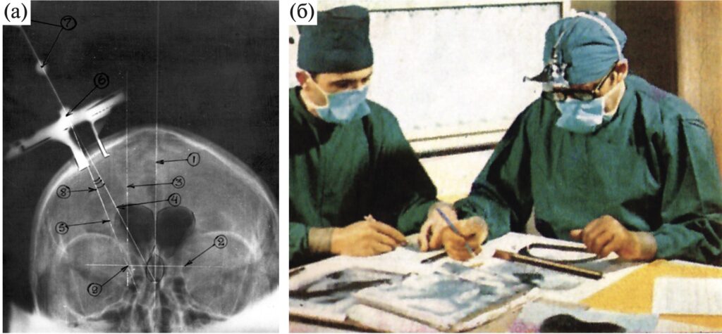 Stereotactic calculations on intraoperative ventriculography. a – ventriculography with target point calculations. b – E.I. Kandel (right) and V.V. Peresedov perform stereotactic calculations in the operating room. 